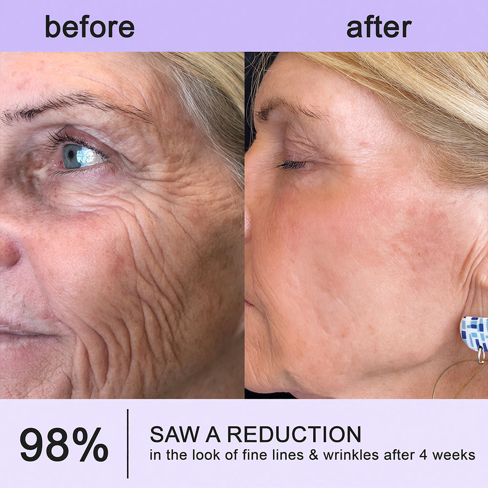 Himilk® Bee Venom & Botox Wrinkle-Lift Tightening Cream 🐝 (Anti-Aging,Hydration, Skin Repair, Acne & Dark Spot Treatment, Wart & Mole Removal, Psoriasis Relief) 🌸- Formulated in Canada