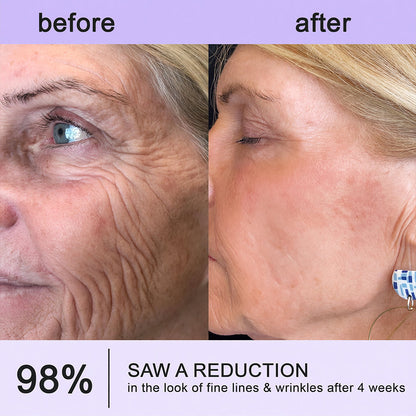 Himilk® Bee Venom & Botox Wrinkle-Lift Tightening Cream 🐝 (Anti-Aging,Hydration, Skin Repair, Acne & Dark Spot Treatment, Wart & Mole Removal, Psoriasis Relief) 🌸- Formulated in Canada