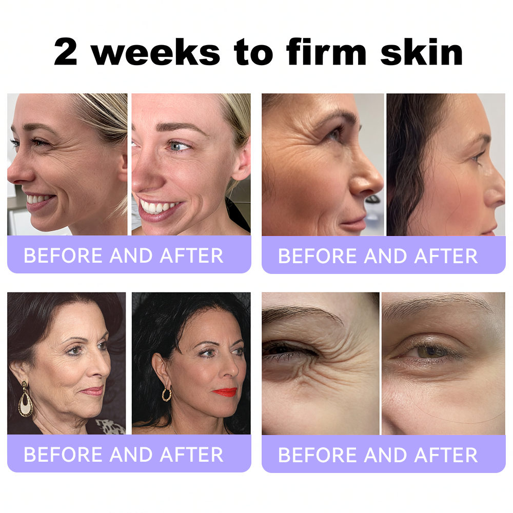 Himilk® Bee Venom & Botox Wrinkle-Lift Tightening Cream 🐝 (Anti-Aging,Hydration, Skin Repair, Acne & Dark Spot Treatment, Wart & Mole Removal, Psoriasis Relief) 🌸- Formulated in Canada