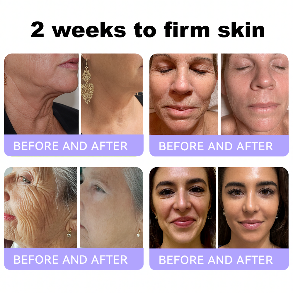 Himilk® Bee Venom & Botox Wrinkle-Lift Tightening Cream 🐝 (Anti-Aging,Hydration, Skin Repair, Acne & Dark Spot Treatment, Wart & Mole Removal, Psoriasis Relief) 🌸- Formulated in Canada