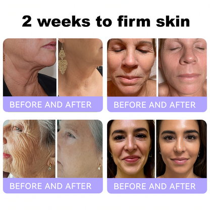 Himilk® Bee Venom & Botox Wrinkle-Lift Tightening Cream 🐝 (Anti-Aging,Hydration, Skin Repair, Acne & Dark Spot Treatment, Wart & Mole Removal, Psoriasis Relief) 🌸- Formulated in Canada