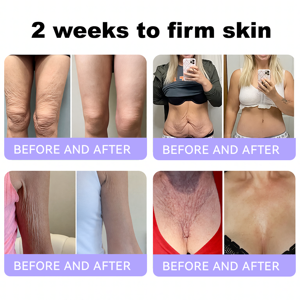Himilk® Bee Venom & Botox Wrinkle-Lift Tightening Cream 🐝 (Anti-Aging,Hydration, Skin Repair, Acne & Dark Spot Treatment, Wart & Mole Removal, Psoriasis Relief) 🌸- Formulated in Canada